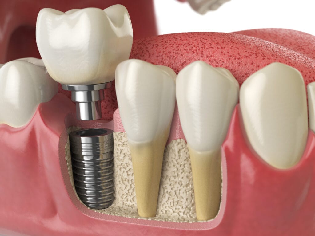 Image of a dental implant and how they work