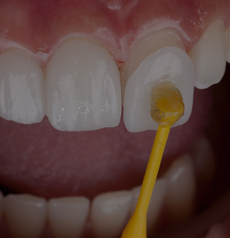 Treatment - Toothcare dental